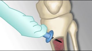 quotPlacement of an Intraosseous Linequot by Monica Kleinman MD for OPENPediatrics [upl. by Laet]