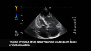 Severe pulmonic regurgitation [upl. by Enomed423]