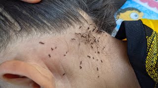 Head lice Removal  How to get rid of lice [upl. by Walliw564]