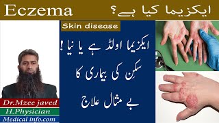 Eczema  What is Eczema  Skin ki bemari ka bemisal ilaj  How to treat it [upl. by Aed]