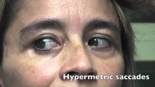 Case Challenge The patient had hypermetric saccades Video 1 [upl. by Halle]