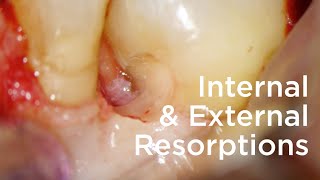 Management of internal and external resorptions  Clinical case [upl. by Garate]