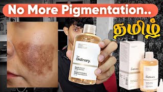 Best to Remove Melasma Pigmentations Deadskin Skin  Tamil Review Ordinary Glycolic Acid [upl. by Kirwin]