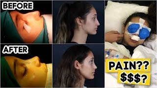 NOSE JOB CHECK COST RECOVERY PAIN before amp after [upl. by Htedirem976]