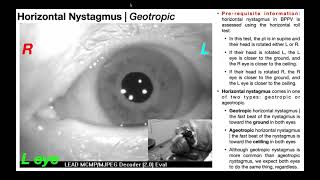 Nystagmus EXPLAINED 👀  Visualizing amp Interpretation [upl. by Ehling]