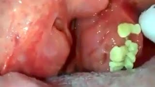 big tonsils stones removal tonsilolith removal big hidden tonsils stone removal [upl. by Des550]