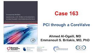 Case 163 Manual of PCI  PCI through CoreValve [upl. by Yorke]