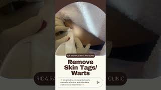 Removing Skin Tag [upl. by Yesrej956]