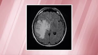 Glioblastoma—the most commonlydiagnosed brain cancer  OSUCCC – James [upl. by Brice]