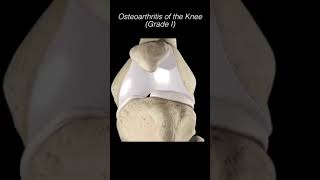 Doctor Explains Knee OSTEOARTHRITIS Grade IIV 🦴 [upl. by Nady191]