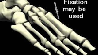 Weil Lesser Metatarsal Osteotomy Severe hammertoe correction procedure [upl. by Clyde]