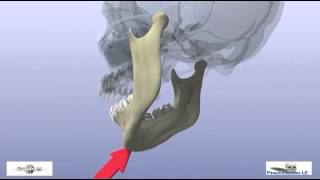 fractures of the mandibular condyle [upl. by Yellah]