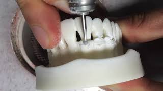 radicular blending amp marginal bone gradualizaion for Crown Lengthening or Alveoloplasty [upl. by Ennovahc]