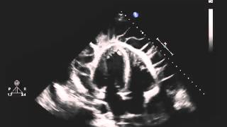 Echocardiogram of a Patient with Uremic Pericarditis [upl. by Isyad]