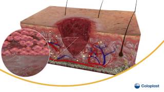 Wound Healing [upl. by Fonsie]