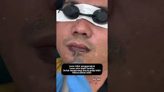 Bibir Hitam Jadi Cerah  Wajib di Coba Treatment Laser Bibir sulamalisrosidi [upl. by Nisaj]