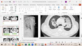 🫁Clase 33 Parte II Insuficiencia Respiratoria Fisiopatología Dr Aguilar [upl. by Adnoel]