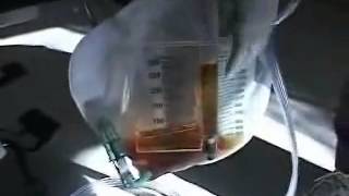 Foley Catheter Tubing and Collection Bag Free Nursing Video Lecture [upl. by Anamor34]