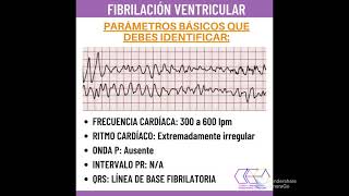 Fibrilación ventricular explicado en 1 minuto [upl. by Lanny]