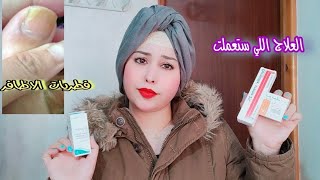 العلاج اللي ستعملت للتخلص من فطريات الاظافر mycoster8nomyc150mg  dermofix 2 [upl. by Gnuoy]