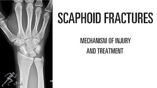 Scaphoid fracture Mechanism of injury and treatment options of this wrist injury [upl. by Giselbert]