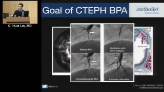 Pulmonary Balloon Angioplasty StateoftheArt Lecture C Huie Lin MD [upl. by Shirlee]