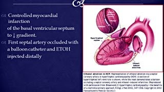 Hypertrophic cardiomyopathy HOCM  Case Presentation [upl. by Epperson212]