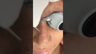 Laser treatment for Freckles  Freckles  Dark spots  lasertreatment [upl. by Byers]