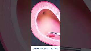 Operative Hysteroscopy  Fibroid amp Polyp removal  Hysteroscopic polypectomy  Types of Hysteroscope [upl. by Weinberg]