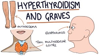 Understanding Hyperthyroidism and Graves Disease [upl. by Aylmer]