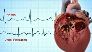 MM  Medical Cardioversion of Atrial Fibrillation in the ER [upl. by Nylidam]