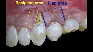 Laterally moved coronally advanced flap [upl. by Warrin]