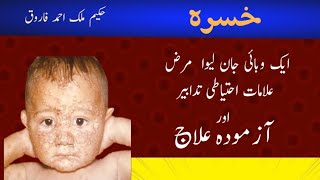 خسرہ کی روک تھام اور علاجA proven remedy for measles [upl. by Schouten]