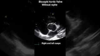 Bicuspid Aortic Valve [upl. by Mackoff]