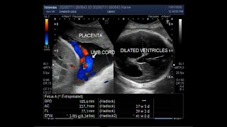 Ultrasound Video showing Cephalopelvic disproportion due to Hydrocephalus [upl. by Madlen355]