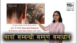 Seborrhoeic Dermatitis Dandruff in Nepali  छाला राेग विशेषज्ञ  Dr Suchana Marahatta  DIP नेपाली [upl. by Yro]