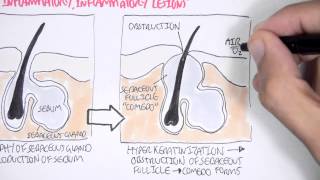 Acne Pathophsyiology [upl. by Annamaria]