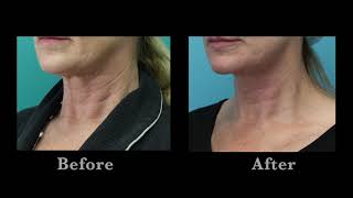 Erbium Resurfacing Laser Treatment for the Neck [upl. by Sucramd]