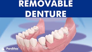 Removable partial denture © [upl. by Eiboj]