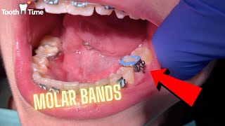 Braces on  getting Molar Bands  Tooth Time Family Dentistry New Braunfels Texas [upl. by Nellac]