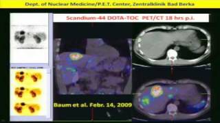 Neuroendocrine Tumors Diagnosis amp Treatment w Peptide Receptor RadiotherapyPRRT Dr Baum 2of2 [upl. by Semela]