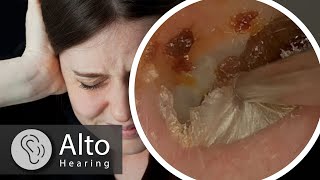 Ear Wax Removal CURES Tinnitus [upl. by Nniuqal868]