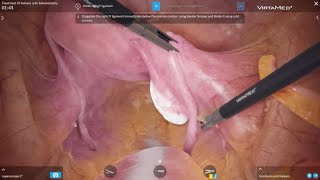 VirtaMed LaparoS™  Treatment of Adnexa with Adnexectomy [upl. by Myron]