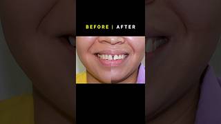 Braces for Gapped teeth 32 month Duration orthodontist braces dentist [upl. by Soph368]