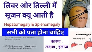 Liver ओर Spleen तिल्ली में सूजन क्यों आती है  Hepatomegaly amp Splenomegaly Causes  symptoms [upl. by Colt520]