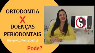 Ortodontia X Doenças Periodontais [upl. by Ynitsed]