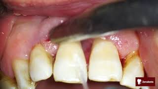 Advanced periodontal disease [upl. by Adel]