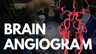 Angiogram  BRAIN angio procedure video [upl. by Horter218]