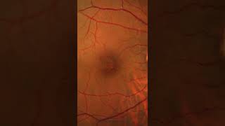 Clear Image of Retina Funduscopy Aankh ka parda Retinal layers  Macula Optics disc [upl. by Wera]