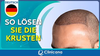 So reinigen Sie die Krusten ab dem 11 Tag nach der Haartransplantation [upl. by Andriette]